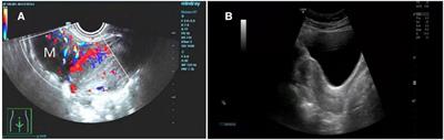 Leiomyoma of the fallopian tube found during laparoscopic myomectomy: A case report and review of the literature